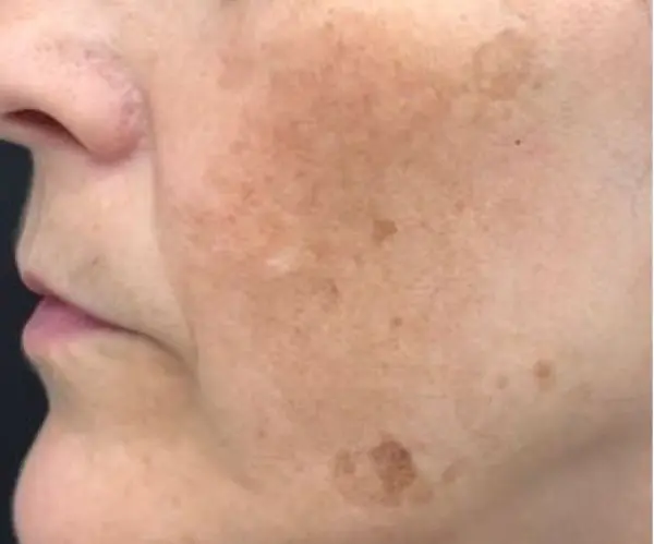 Pigmentation Facial before