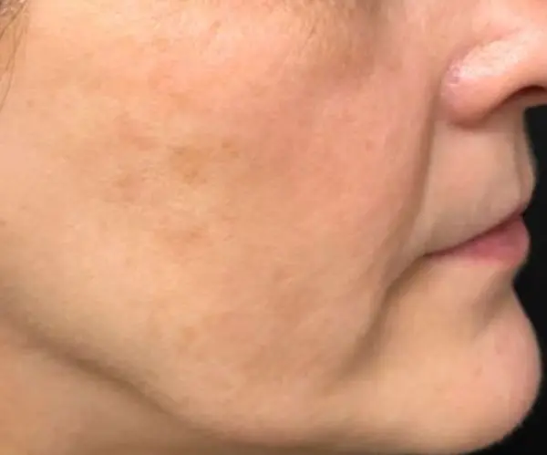 after Picosecond Laser