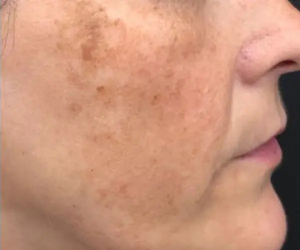 before Picosecond Laser