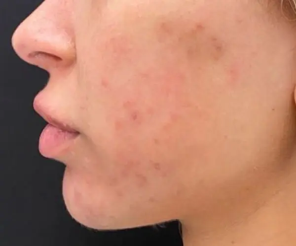 Rosacea Facial before