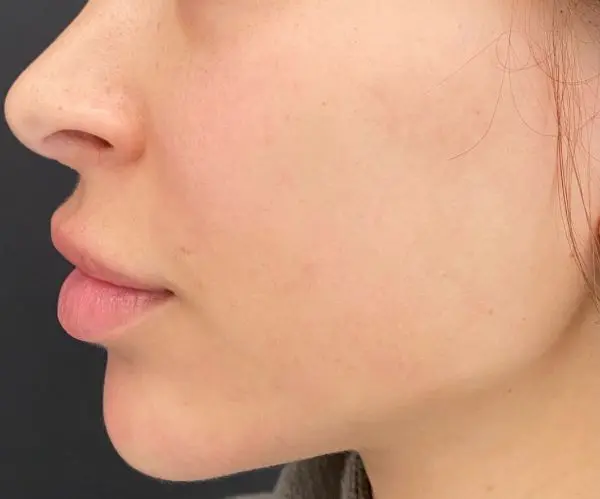 Rosacea Facial after