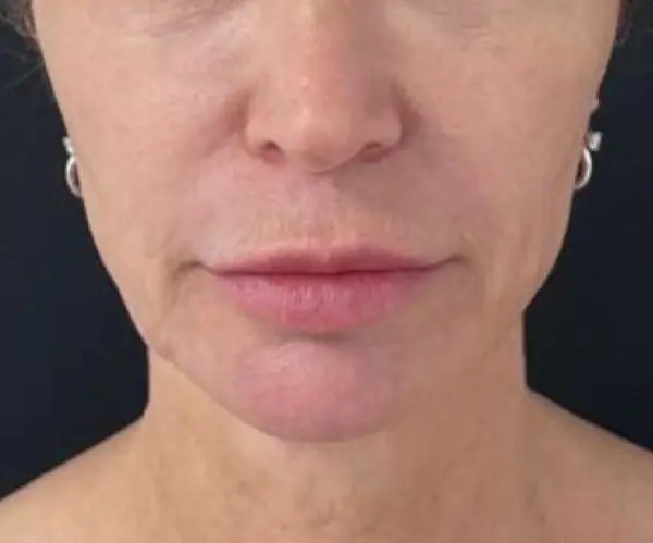 Sculptra