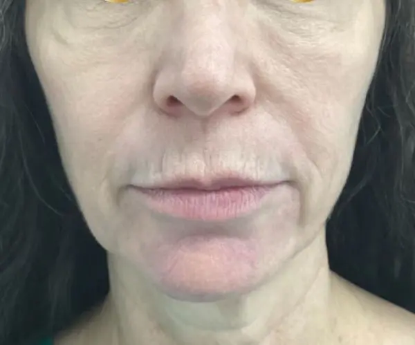 before Sculptra