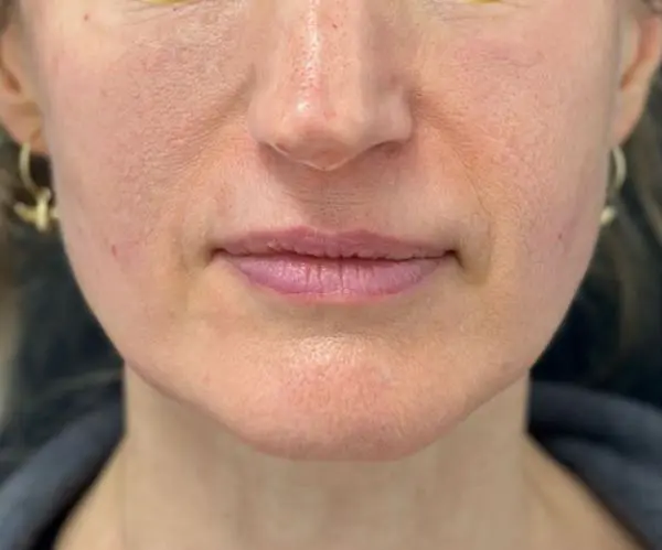 Sculptra