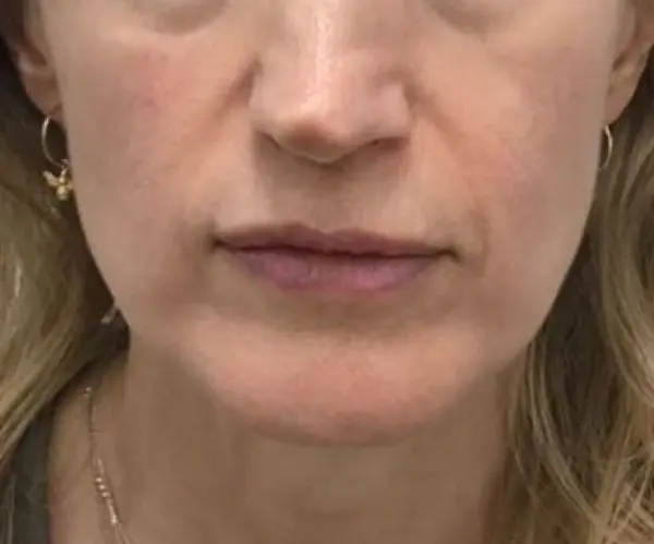 Sculptra
