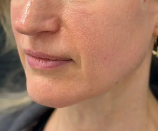 Sculptra