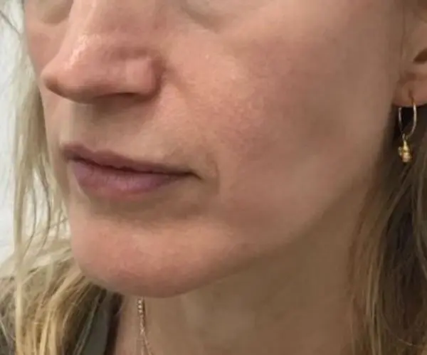 Sculptra