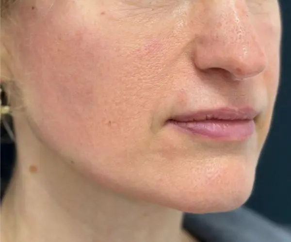 Sculptra