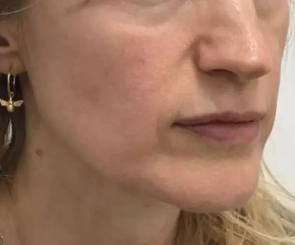 Sculptra