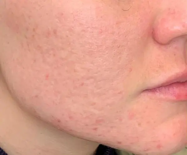 Laser Skin Resurfacing after