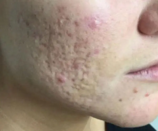 Laser Skin Resurfacing before