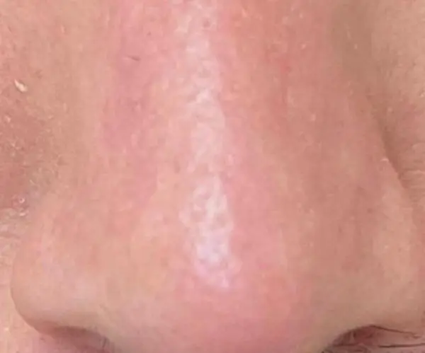 Laser skin resurfacing treatment in London