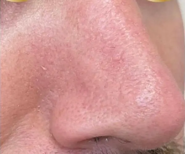 Laser Skin Resurfacing after
