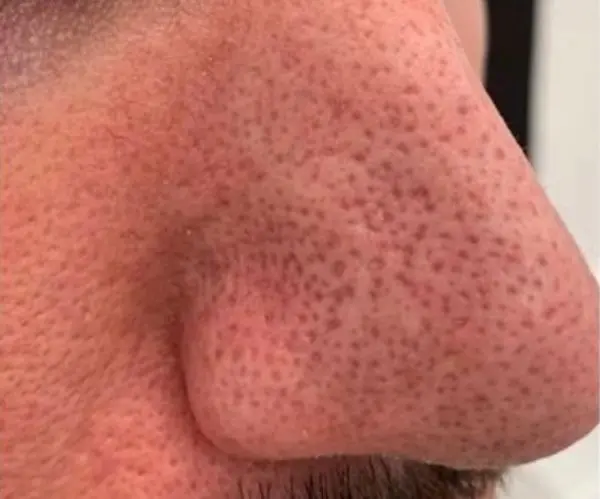 Laser Skin Resurfacing before