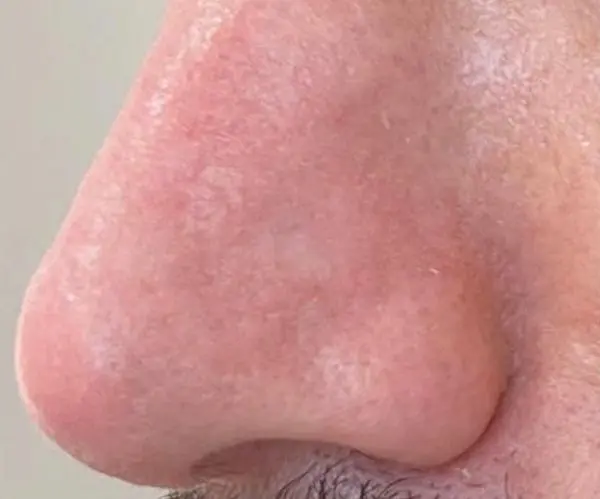 Laser Skin Resurfacing after