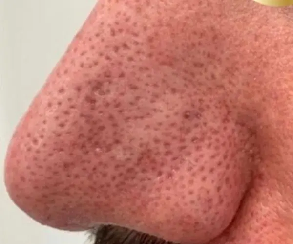 Laser Skin Resurfacing before