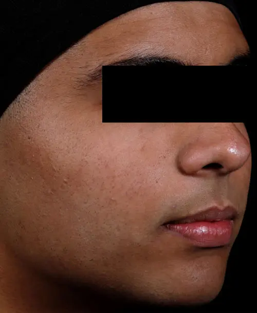 AviClear acne treatment after