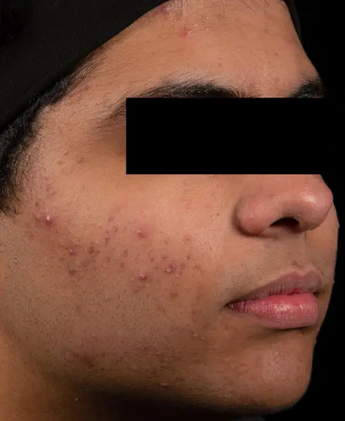 AviClear acne treatment before