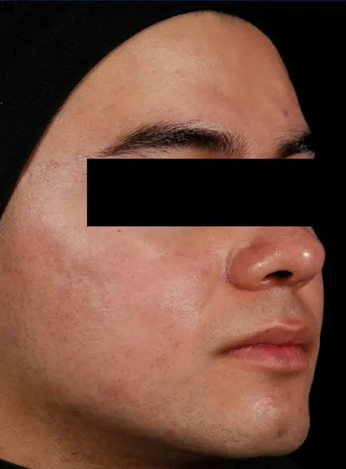 AviClear after