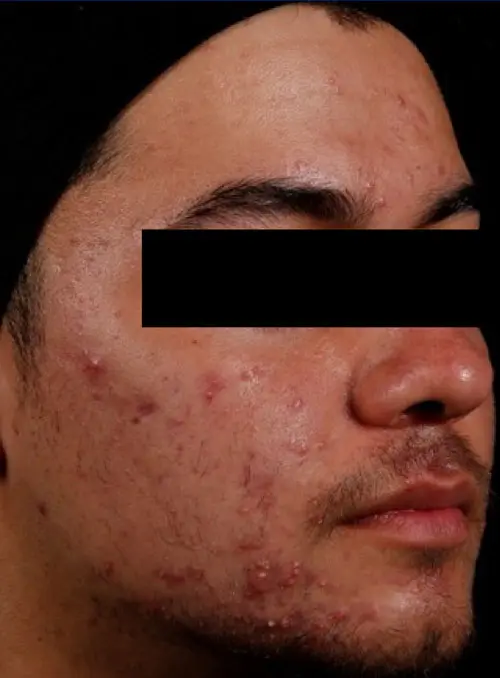 AviClear before