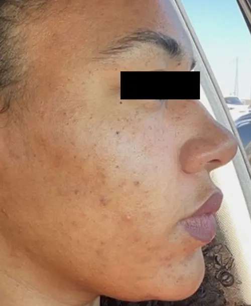 AviClear treatment after