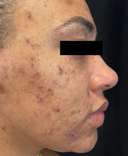AviClear acne treatment before