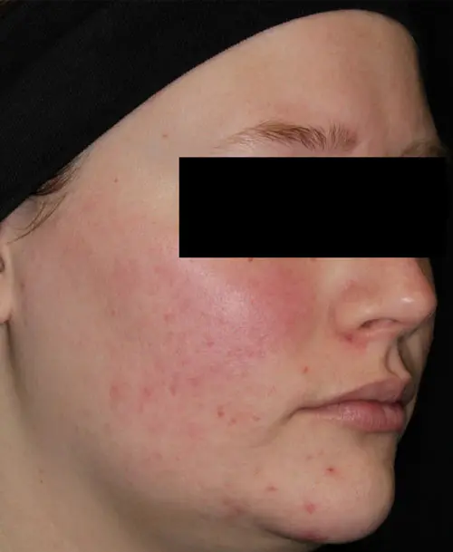 AviClear acne treatment after