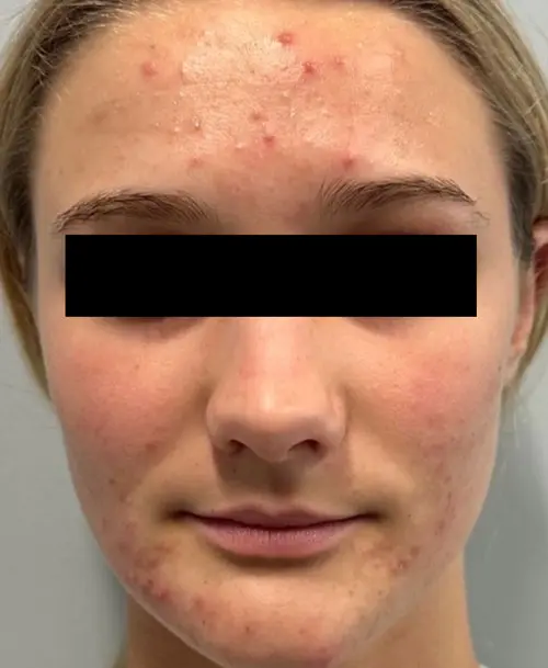 AviClear acne treatment before