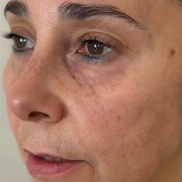 Dr Tatiana - BioFiller Before