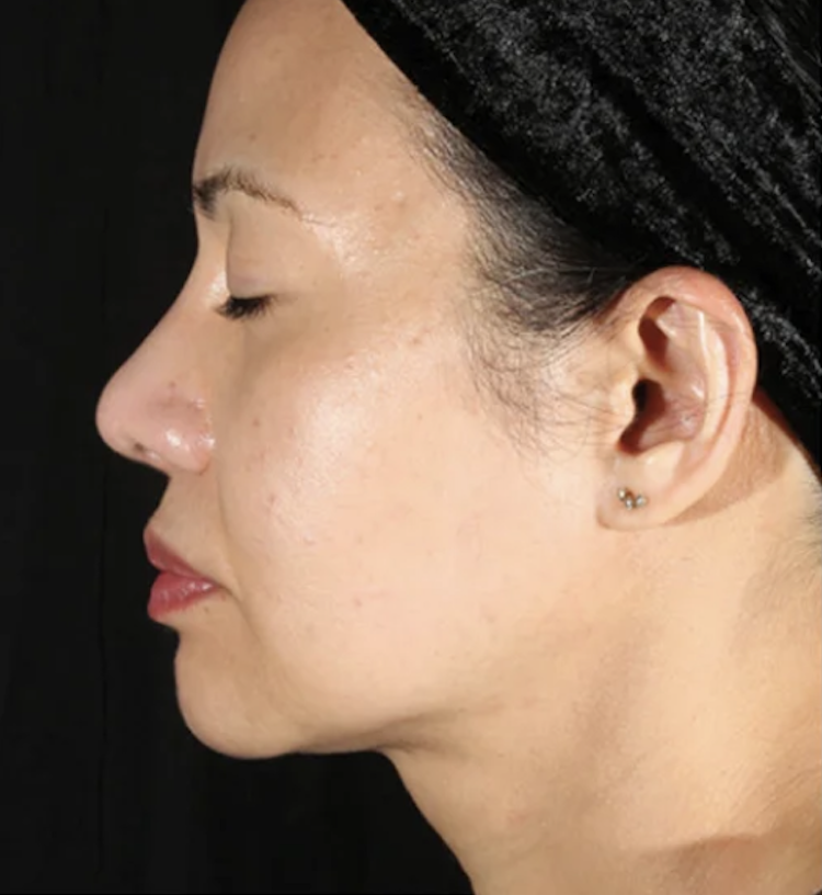 xerf treatment london