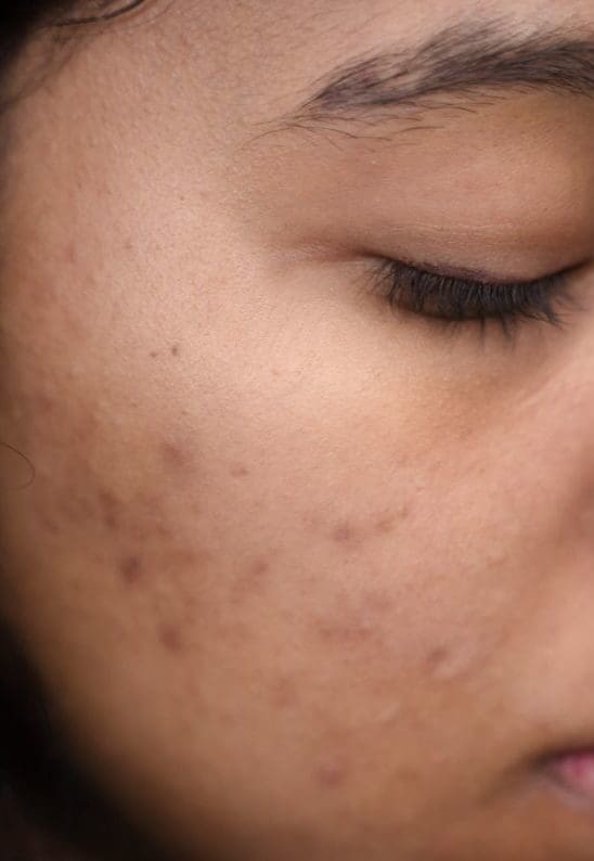 Acne Scars