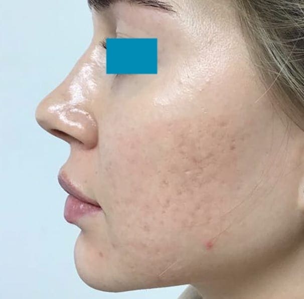 Laser Acne Treatment - After 03
