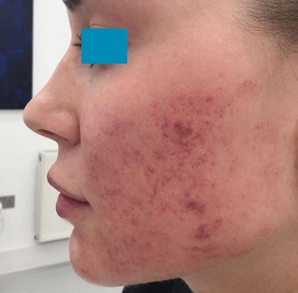 Laser Acne Treatment - Before 03