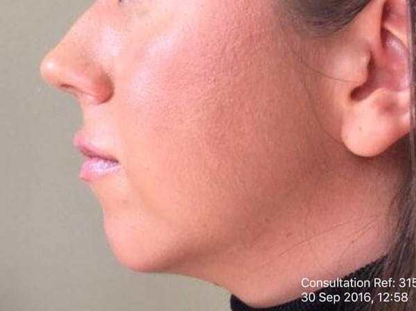 Dermal Fillers - Chin - Before 01