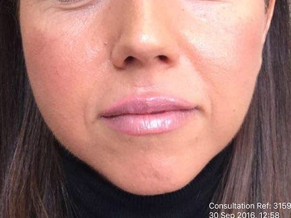 Dermal Fillers - Chin - Before 02