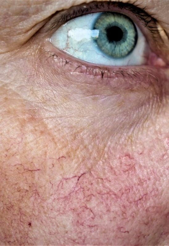 Facial Thread Veins