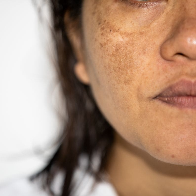 Hyperpigmentation