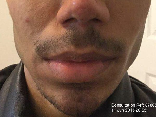 Jawline Dr Tatiana Lapa Harley St Aesthetic Specialists