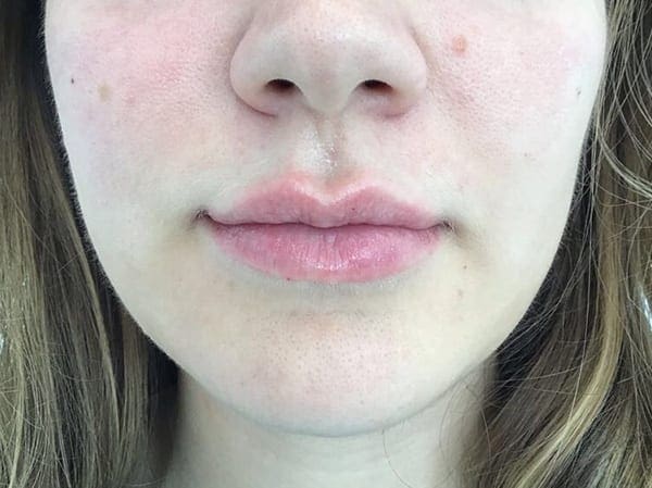 lip filler swelling stages