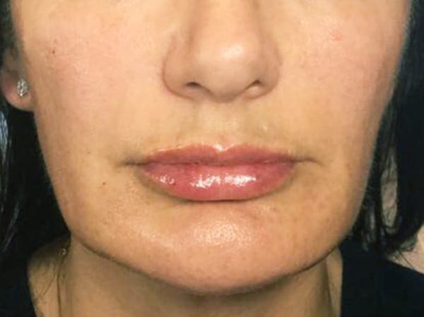 Dermal Fillers - Marionette Lines - After 01