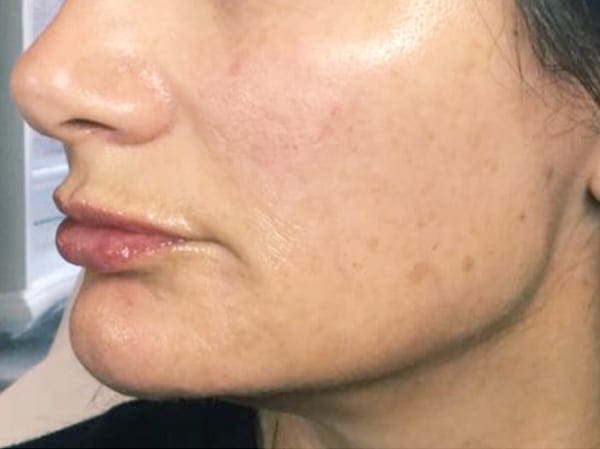 Dermal Fillers - Marionette Lines - After 02