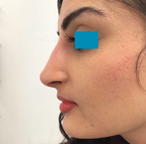 Dermal Fillers - Nose - After 01