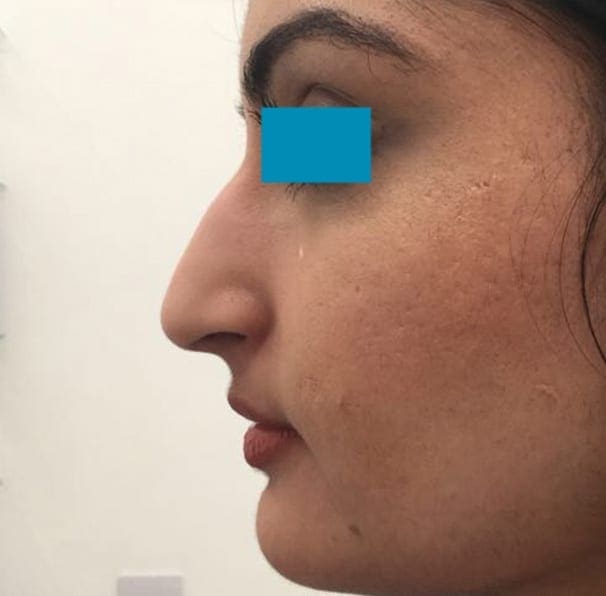 Dermal Fillers - Nose - Before 01