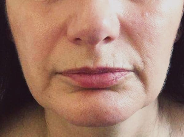 Dermal Fillers - Nasolabial Folds - Before 01