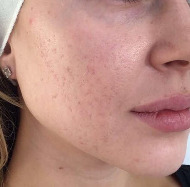 Laser Rosacea Treatment - After 01