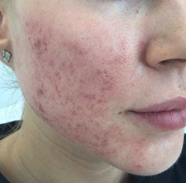 Laser Rosacea Treatment - Before 01