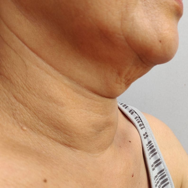 How to lose sales neck fat lines