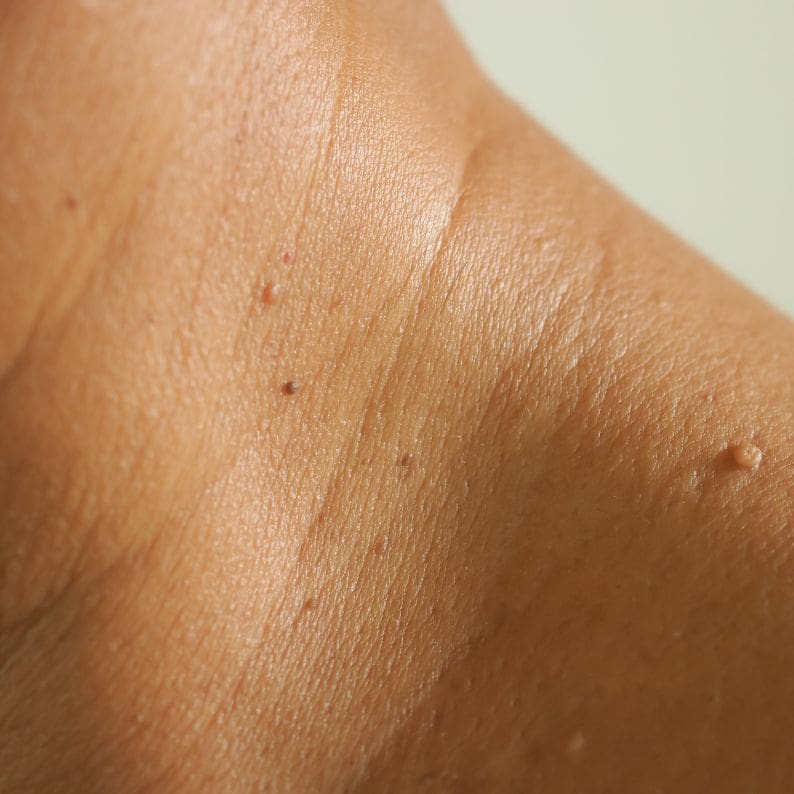 Skin Tags