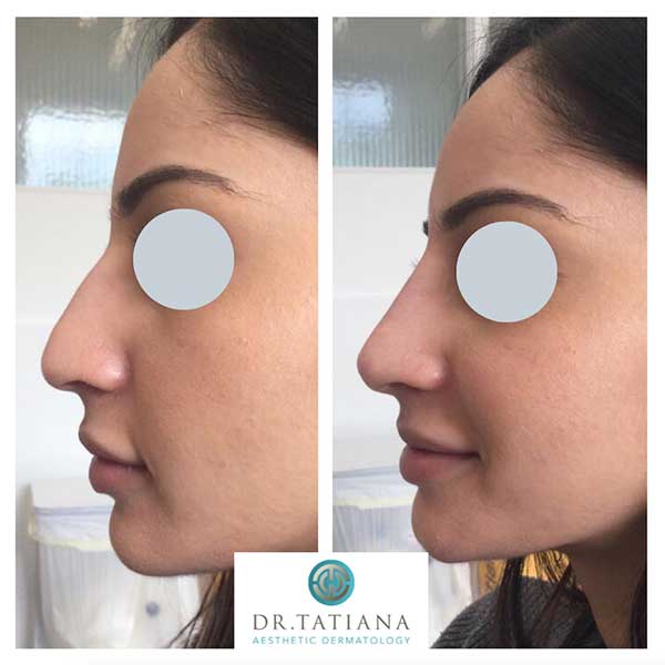 Rhinoplasty Masterclass