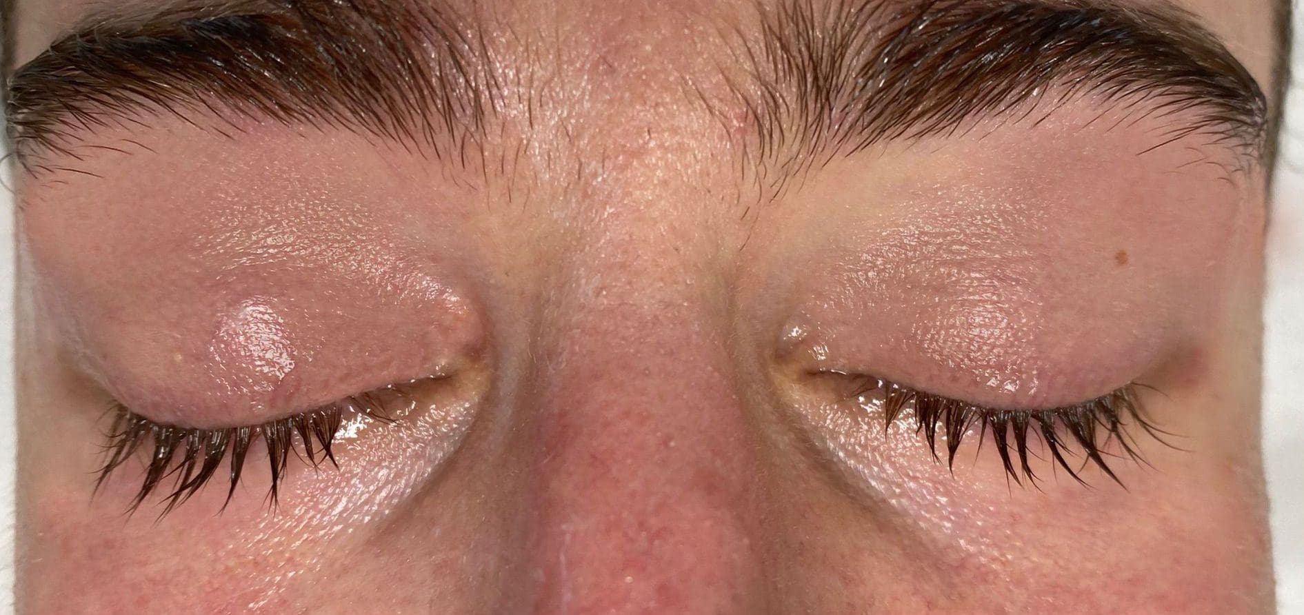 Eyelid / Periorbital Vein Laser | Drs Tatiana + Rishi Aesthetics